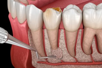 chirurgische Zystenentfernung an Zahn 3