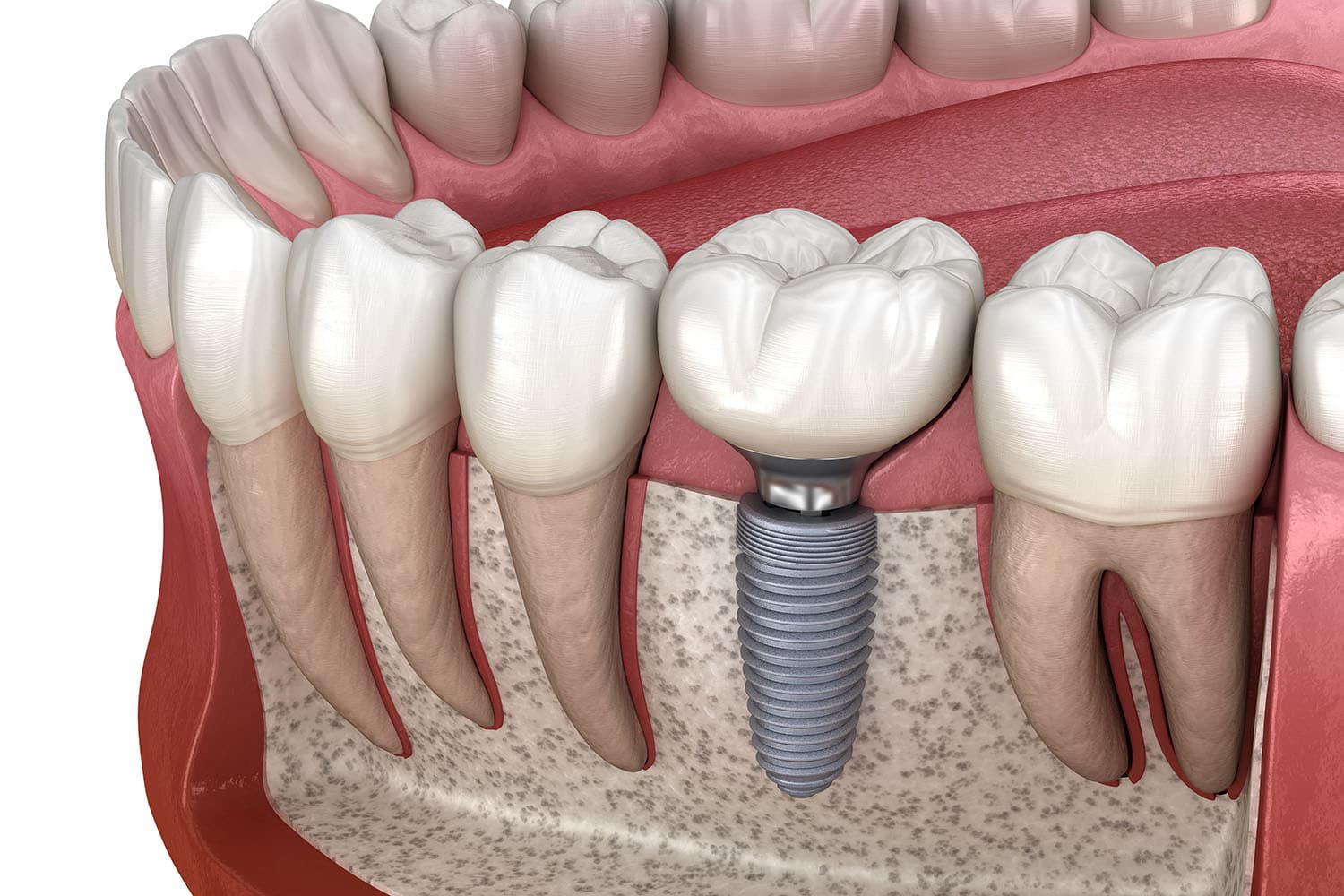 Illustration: metallfreieres Zahnimplantat zwischen natürlichen Zähnen